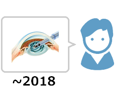 白内障手術感想