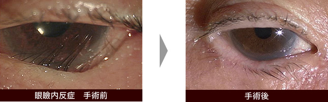 眼瞼内反症手術前・手術後