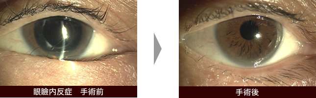 眼瞼内反症手術前・手術後