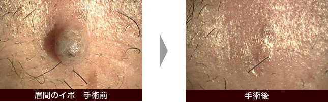 眉間のイボの手術前・手術後