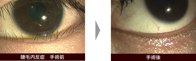 睫毛内反症手術前・手術後