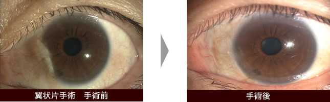 翼状片手術前・手術後