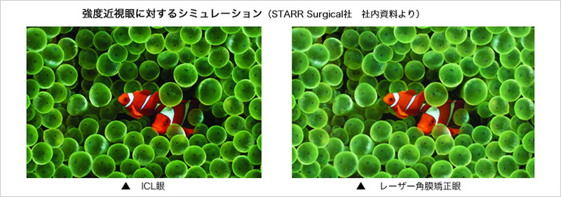 強度近視眼に対するシミュレーション