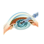 日帰り白内障手術