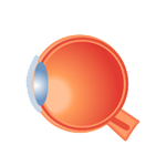 低侵襲緑内障手術(iStent、カフーク、マイクロフック)・緑内障治療